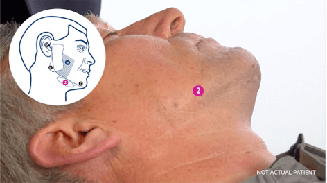 xeomin-injection-video